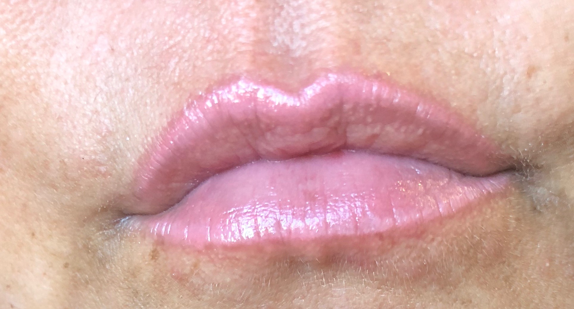 Tammy 1 day after Permanent Lip Enhancement-1