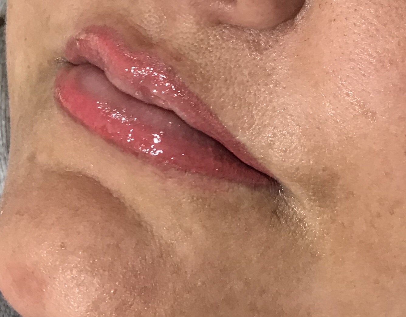 Tammy Immediately after Permanent Lip Enhancement-2
