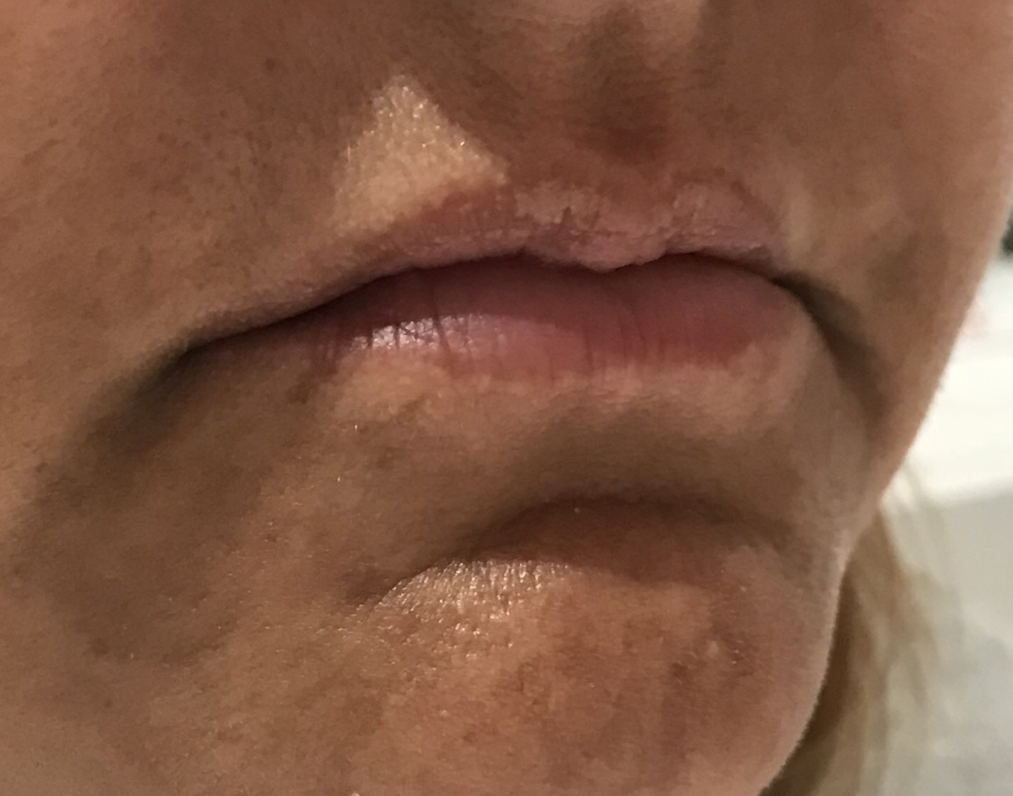 Tammy before Permanent Lip Enhancement-2