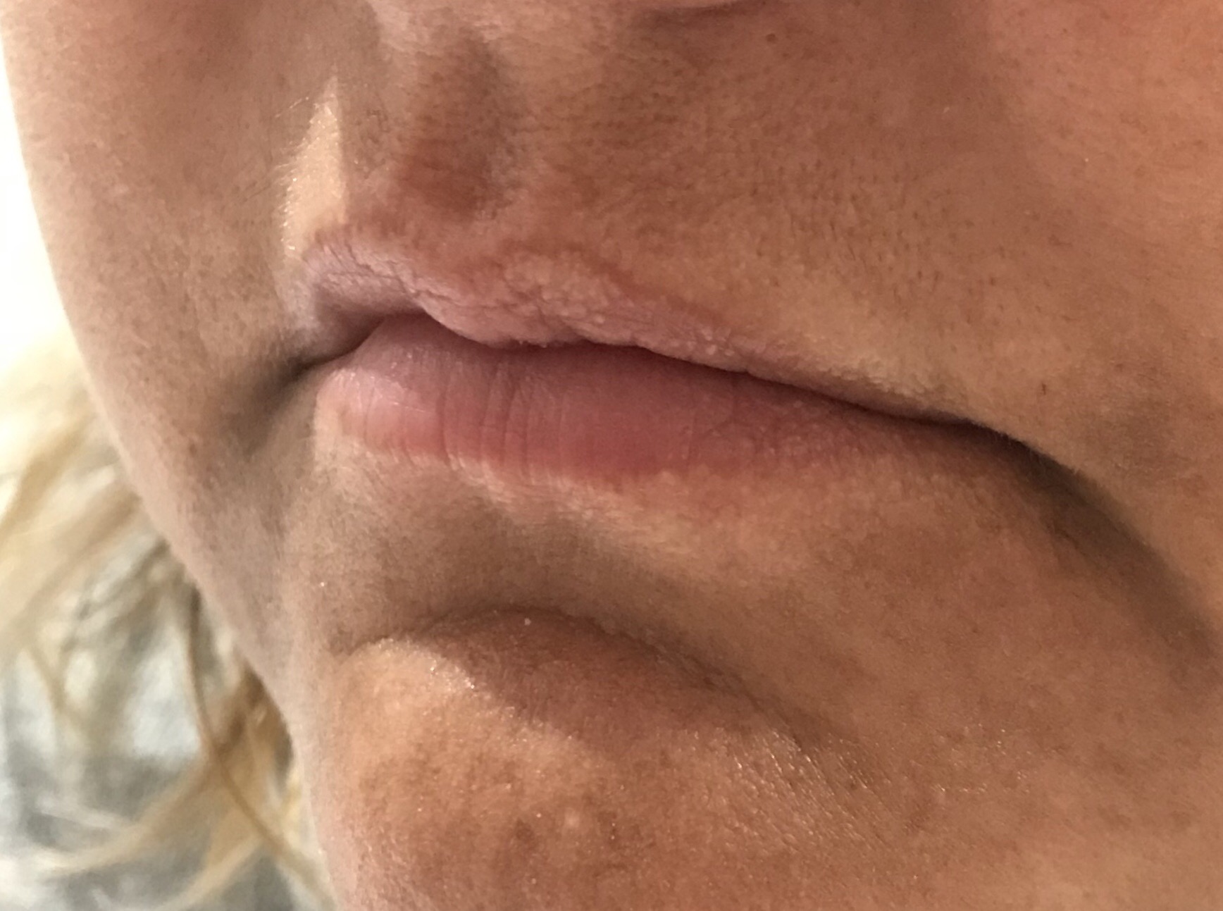 Tammy before Permanent Lip Enhancement-3