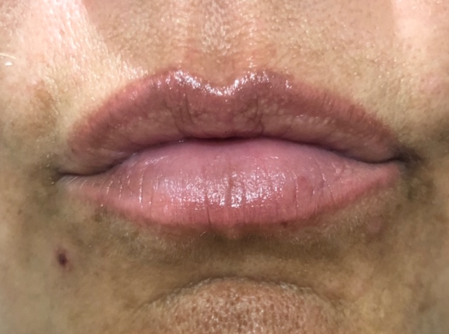 Tammy healed Permanent Lip Enhancement-1